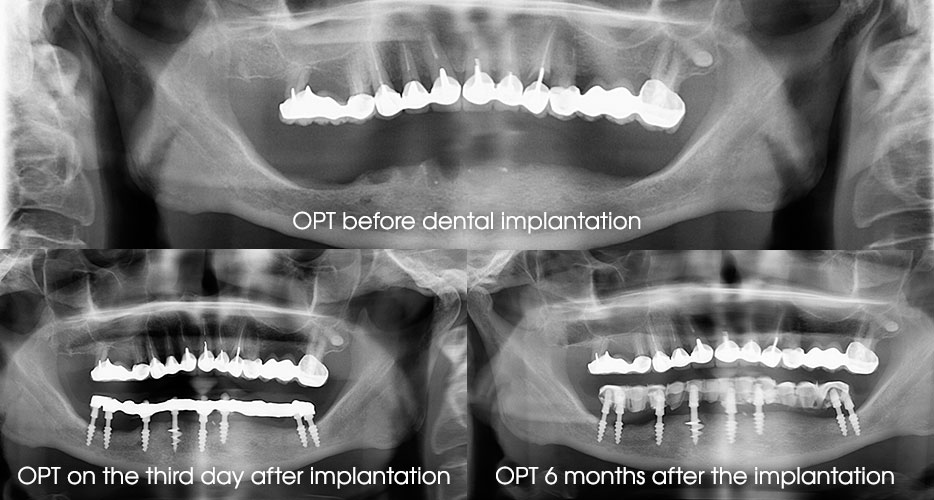 Fig. 10. Roentgenology before and on the fixed dates after the dental implantation.