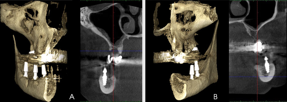 Fig. 2. The computer tomography after the implant insertion (A – right side, B – left side)