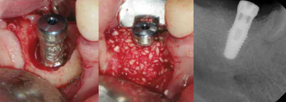 FIG 6: Implant site exposure and placement of allograft substitute particulate at the site