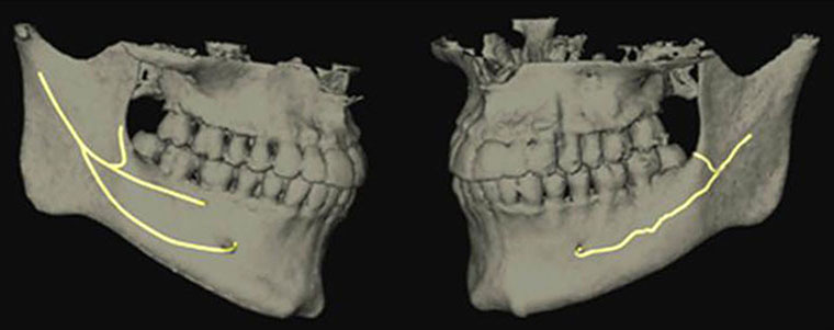 Fig. 1.Reconstruction with nerve tracking showing the bifid and trifid mandibular canals (Mizbah K. et al., 2012) [40].