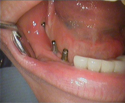 Fig. 5. Clinical presentation of the oral cavity after implantation.