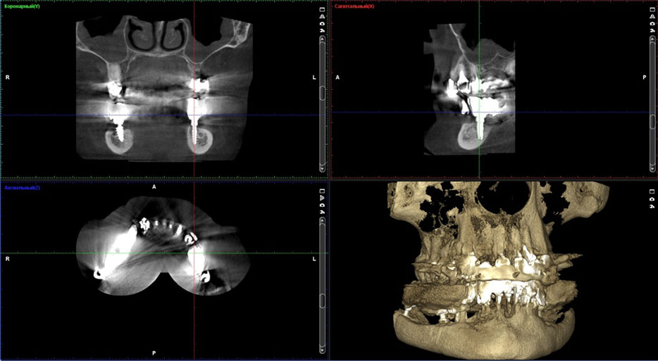 Fig. 7. The computer tomography 6 months after the implant insertion