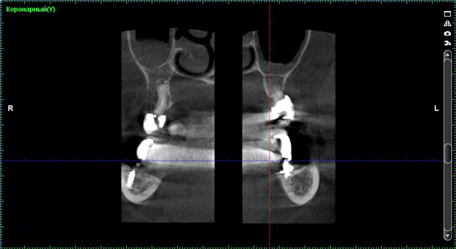 Fig. 8. The computer tomography 6 months after the implant insertion in the posterior region of the mandible.