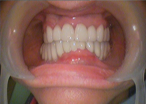 Fig. 11. Clinical presentation of the oral cavity after fixation of dental prostheses.